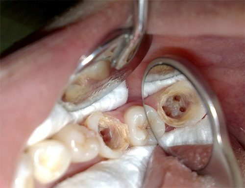 Очищенные зубные каналы