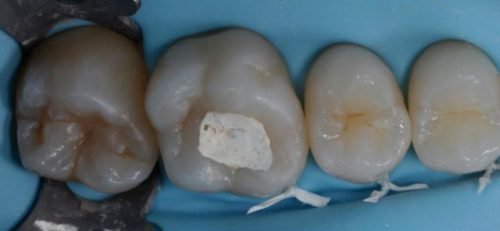 Мышьяк под временной пломбой у зубе