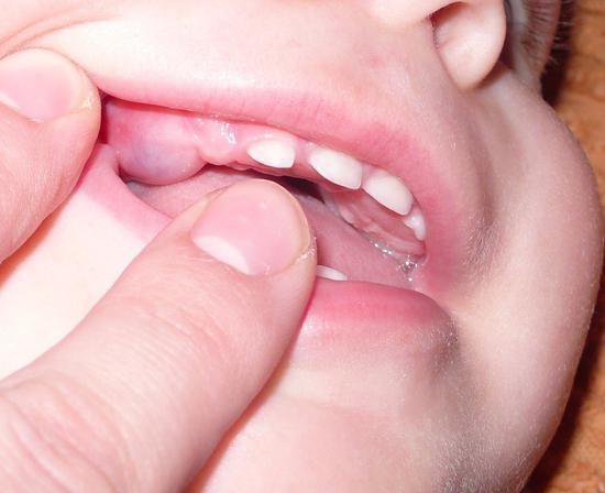 Гематома на десне - растет зуб