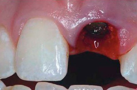 Как выглядит десна после удаления зуба