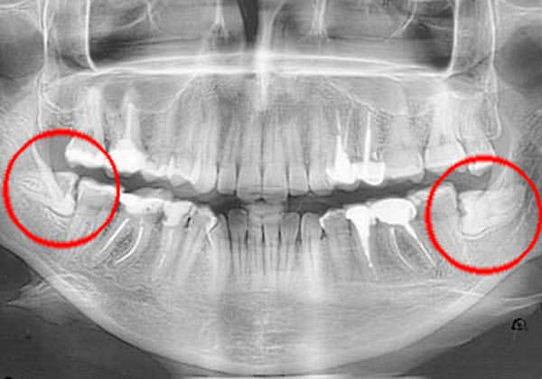 Ретинированный зуб рентген
