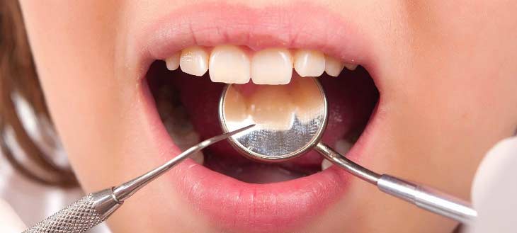 Какие зубные пломбы лучше ставить?