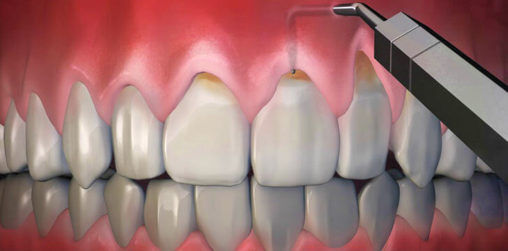 Что делать если оголилась шейка зуба и каковы причины заболевания?