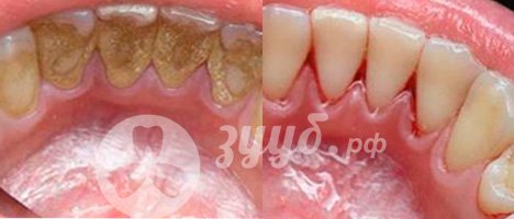 Устранение образований на зубах